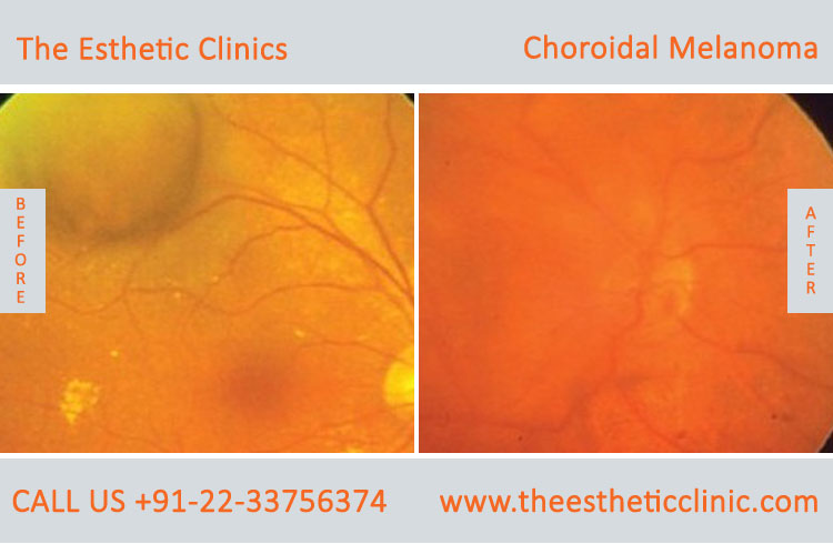 Choroidal Melanoma Eye Cancer Treatment before after photos in mumbai india (1)